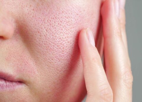 Pelle del viso irritata e arrossata